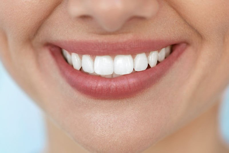 blanqueamiento-dental-en-barcelona