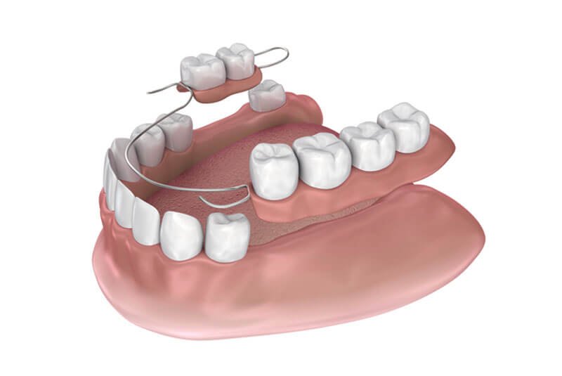 prótesis-parcial-removible-o-esqueléticos-clínica-dental-vas-en-barcelona