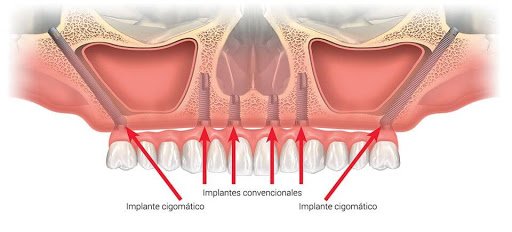 implantes-cigomáticos-barcelona-clinica-dental